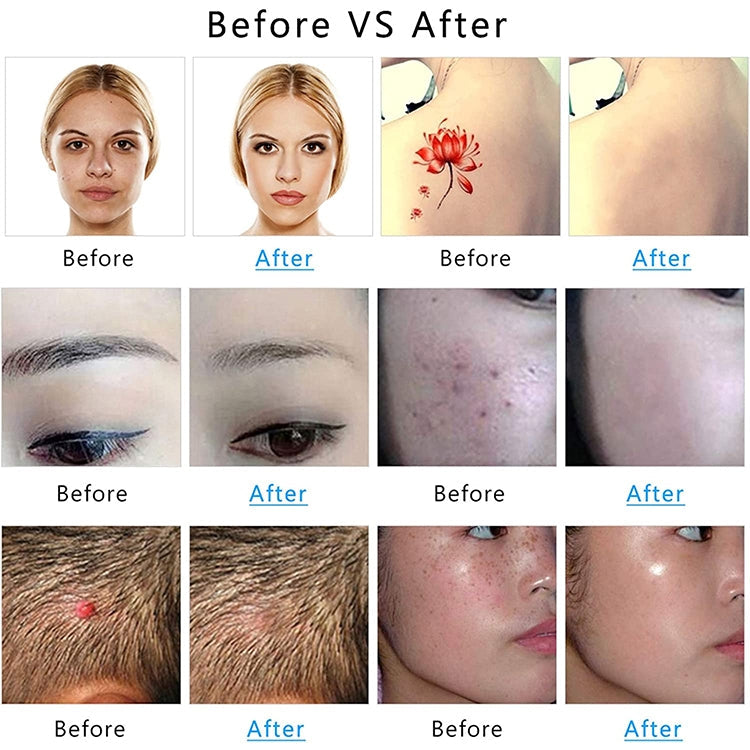 AA-A401 Small Freckle and Mole Removal Pen Tattoo and Eyebrow Removal Beauty Instrument, Red Light Plug-in, Blu-ray Plug-in, Red Light Battery, Blu-ray Battery